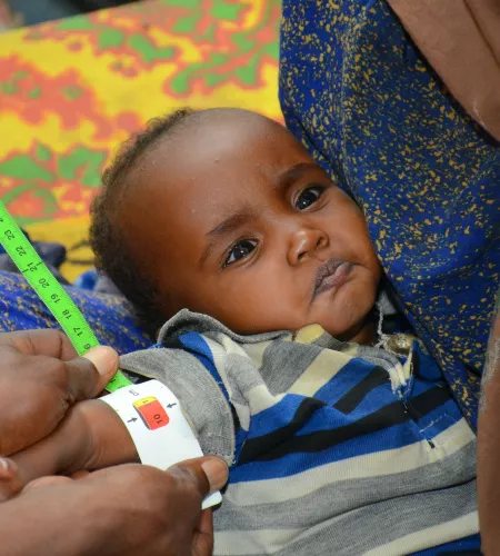 Nahrungsmittelkrise: Ein Maßband zeigt starke Unterernährung bei einem afrikanischen Kind